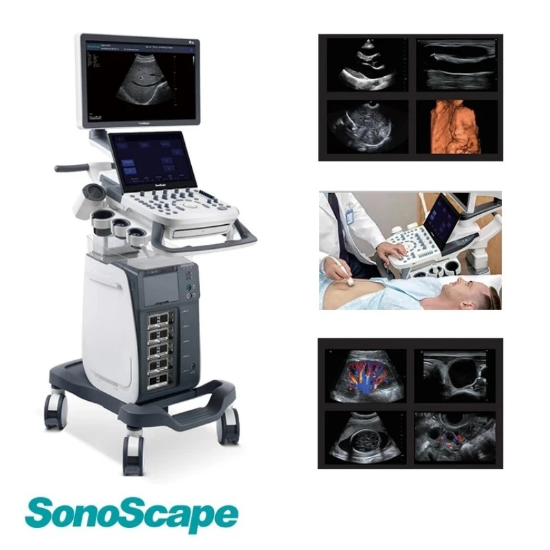 sonoscape ultrasound p15 sonoscape ultrasound p15